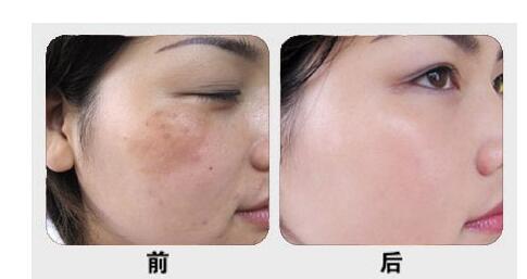 黃褐斑一化斑湯