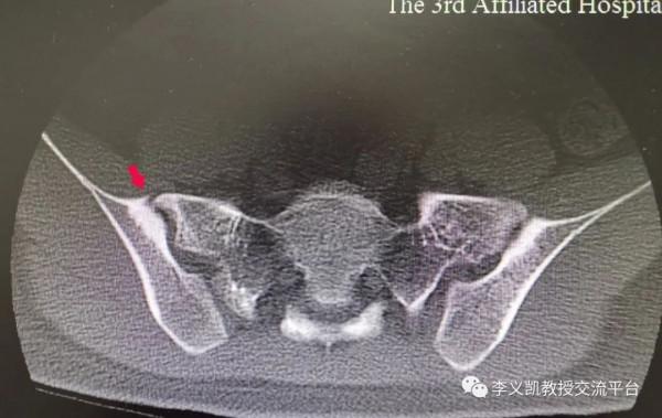 唉！又一例確診