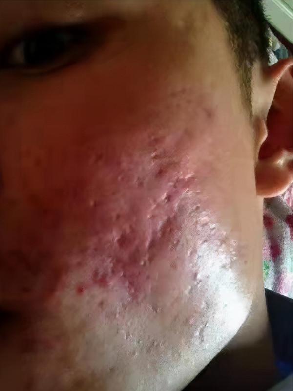 小夥5年老舊痘坑痘印,積極接受治療稱:面部痘坑痘印快消失了 小夥5年老舊痘坑痘印,積極接受治療稱:面部痘坑痘印快消失了