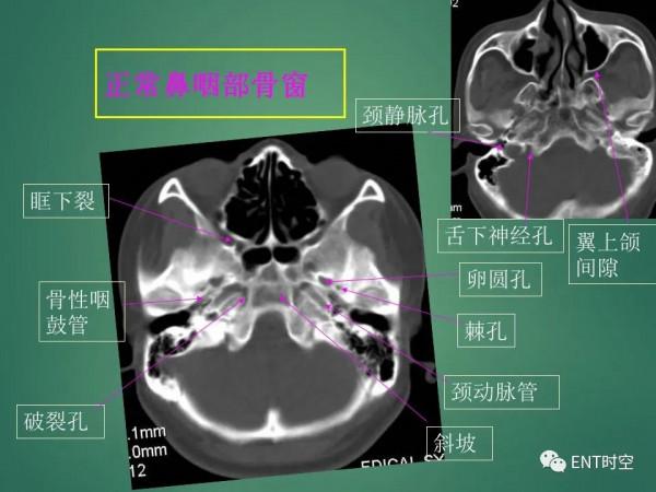 頭頸五官CT斷層解剖圖及常見病影像診斷