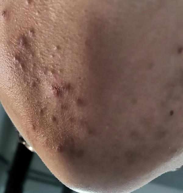 吐血三年“戰痘”，停止在臉上折騰以後，面板再也沒長過痘