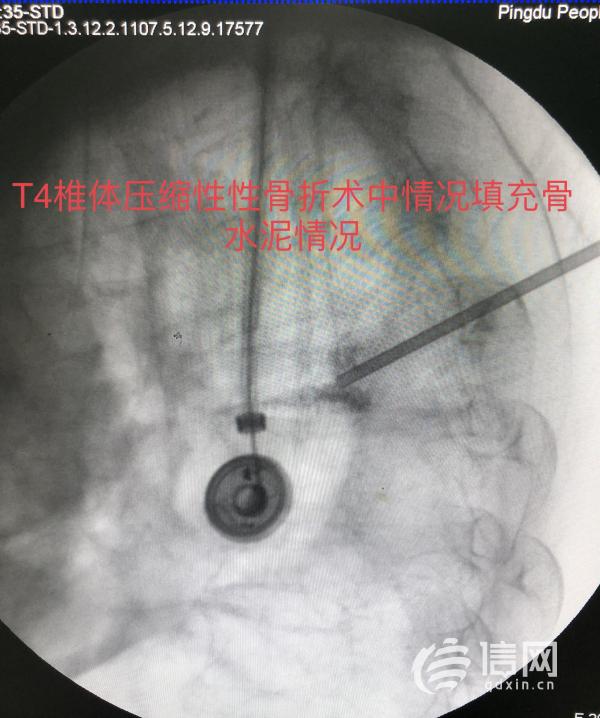 高齡患者遭遇車禍 平度市人民醫院微創手術恢復健康
