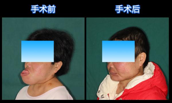 女子長著一張“猿臉”，30年無法見人！醫生為她重建五官，實現從“猿”到人