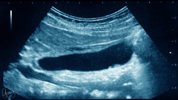 別再把消化不良當胃病！或許是膽囊不好了，聽聽醫生怎麼說