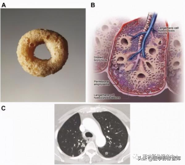 22個肺部疾病的CT徵象 22個肺部疾病的CT徵象