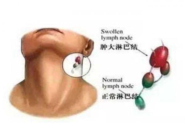 哪些原因可以引起淋巴結腫大？發現淋巴結腫大應該怎麼辦？