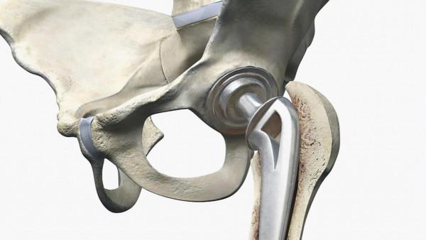 老人股骨頸骨折，關節置換，還是螺釘固定？看看醫生怎說