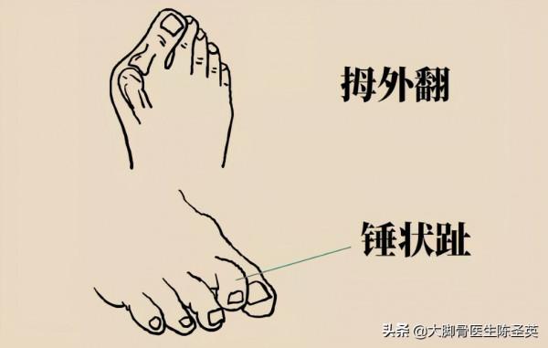 腳底板愛長繭子,走路疼痛到底是怎麼回事? 腳底板愛長繭子,走路疼痛到底是怎麼回事?