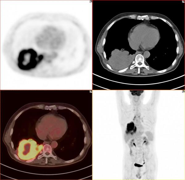 PET/CT病例（1）：晚期肺癌治療3個月，老人重現希望和曙光