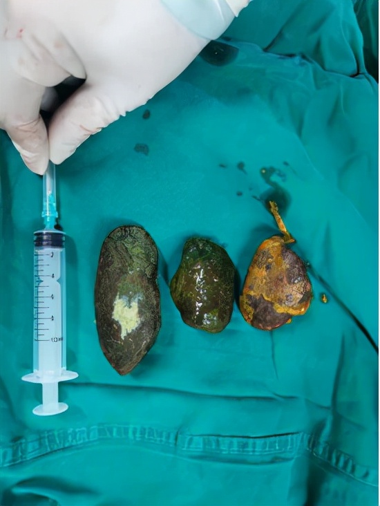 16歲少年愛吃柿子和辣條，肚子里長了3顆大石頭