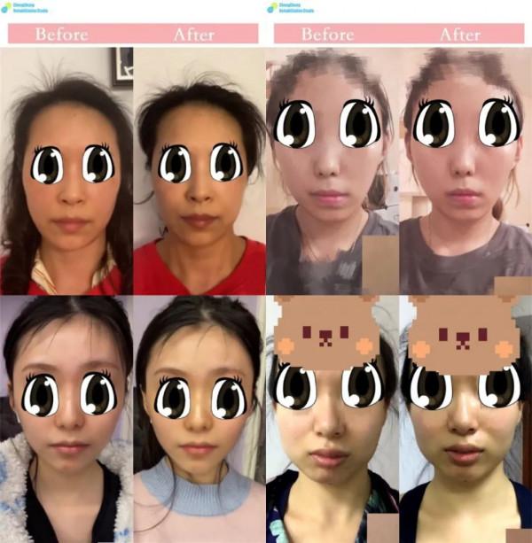 什麼樣的面部問題，可以透過運動來矯正？