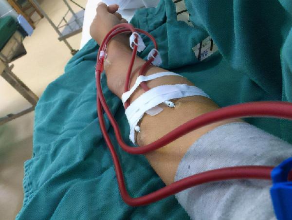 一名尿毒症患者的懺悔：忽視小病、暴飲暴食，如今靠透析活命