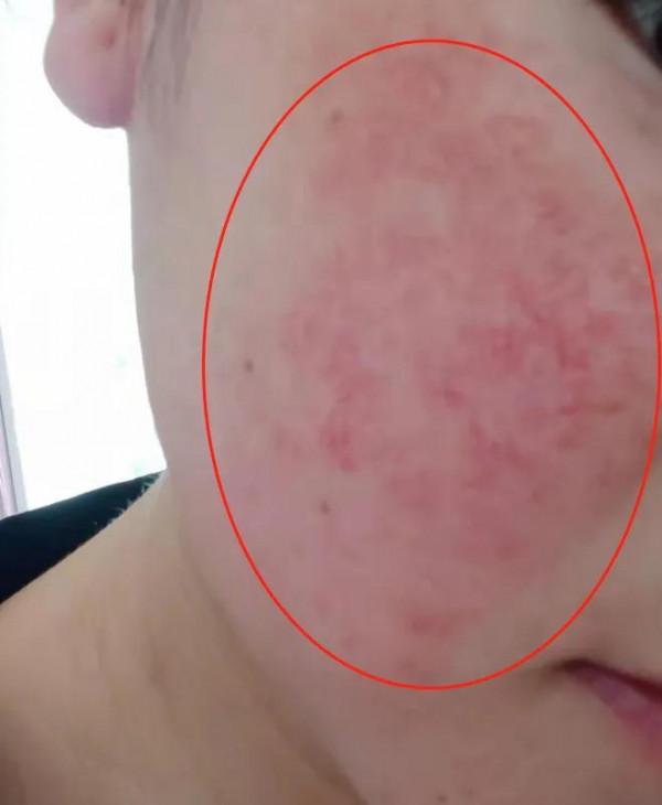 特別容易過敏臉紅,角質層薄終於修復好了 特別容易過敏臉紅,角質層薄終於修復好了