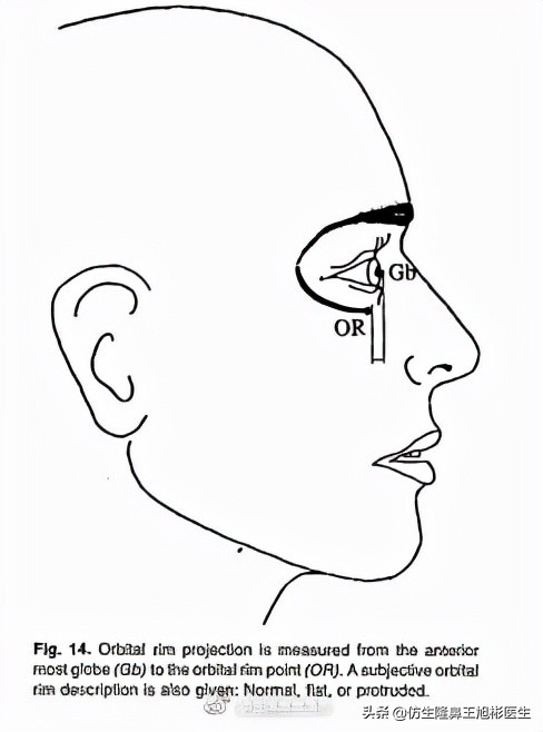 隆鼻就能提升面部立體感?不,有效和無效手術,關鍵在於它 隆鼻就能提升面部立體感?不,有效和無效手術,關鍵在於它