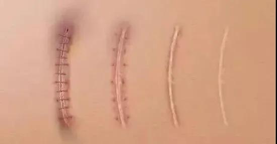 兒童外傷，不想留疤怎麼辦？