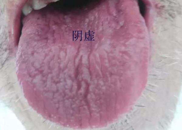 舌頭有裂紋就是陰虛嗎?教你形象地認識四種裂紋舌,十種舌象 舌頭有裂紋就是陰虛嗎?教你形象地認識四種裂紋舌,十種舌象