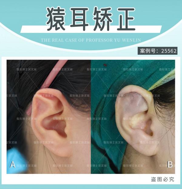 「科普」猿耳是招風耳嗎？兩者有什麼區別？