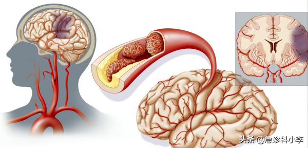 腦梗來臨，睡覺先知？提醒：睡覺出現3個異常，或是腦梗“預警”