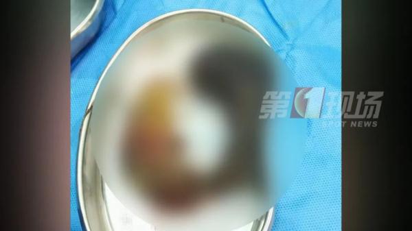 女童腹痛,竟是吃的東西“不尋常”……它們佔了胃部三分之一 女童腹痛,竟是吃的東西“不尋常”……它們佔了胃部三分之一