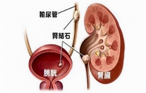 腎結石危害大,預防治療怎麼做?醫生:4種更容易得腎結石 腎結石危害大,預防治療怎麼做?醫生:4種更容易得腎結石