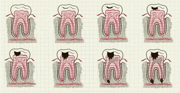 天天刷牙為啥還長蛀牙?也許你忽視了這些事兒…… 天天刷牙為啥還長蛀牙?也許你忽視了這些事兒……