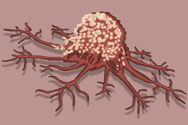 癌症是如何“殺死”一個人的？它也會因此而死，為何還那麼做？