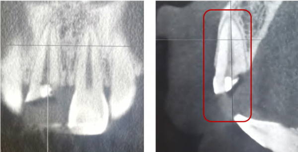 牙齒受了外傷，你知道該怎麼辦嗎？