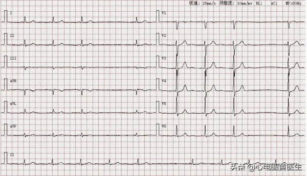 心電圖讀圖練習 心電圖讀圖練習