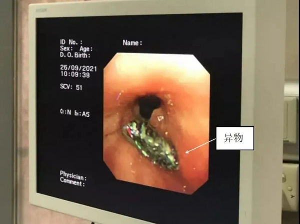 50歲大叔因為一頓飯,咳嗽胸痛了兩年,醫生坦言:他犯的錯很常見 50歲大叔因為一頓飯,咳嗽胸痛了兩年,醫生坦言:他犯的錯很常見