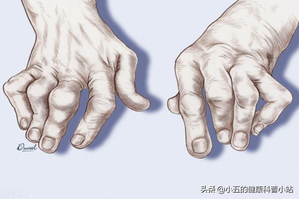 為什麼勸老年人多吃葉酸,科學服用可以防治5種疾病 為什麼勸老年人多吃葉酸,科學服用可以防治5種疾病