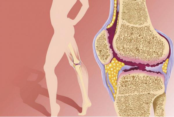 老年人骨關節炎吃氨糖就可以?專家給出一線用藥,療效更確切 老年人骨關節炎吃氨糖就可以?專家給出一線用藥,療效更確切