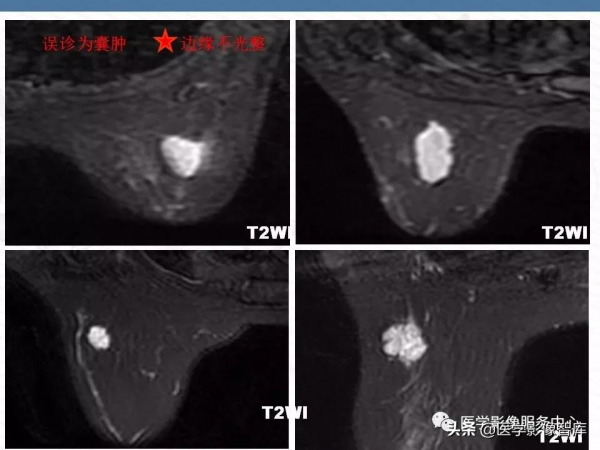乳腺T2WI高訊號腫瘤病變的診斷思路 乳腺T2WI高訊號腫瘤病變的診斷思路