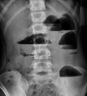 女孩好多天都不排便，因為吃石榴不吐籽兒？醫生：幸好去醫院及時