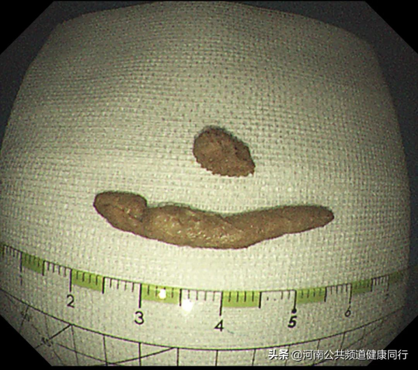 “偽裝的糞石”——在鄭大一附院進行的一例特殊的盲腸隆起型病變內鏡下治療