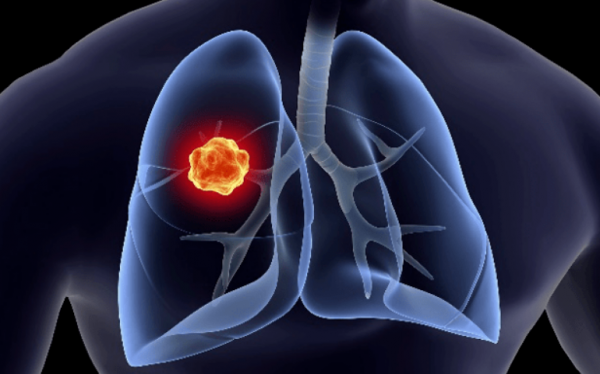 確診到病逝,塗們僅僅堅持了一個月,為何這些癌症發現就是晚期? 確診到病逝,塗們僅僅堅持了一個月,為何這些癌症發現就是晚期?