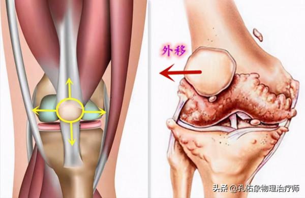 膝關節疼痛的元兇是什麼?骨性關節炎嗎?要如何應對?請看此文 膝關節疼痛的元兇是什麼?骨性關節炎嗎?要如何應對?請看此文