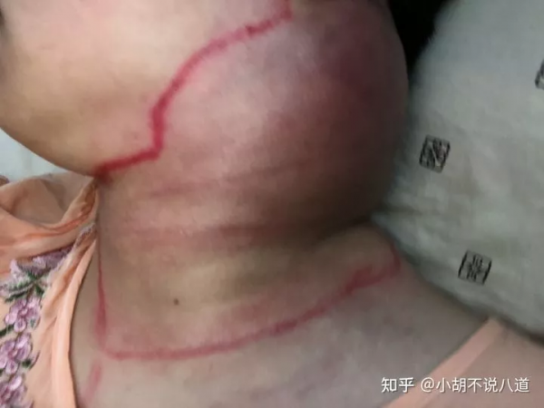 2個月拖成晚期，我錯過了這些黃金癌症警示