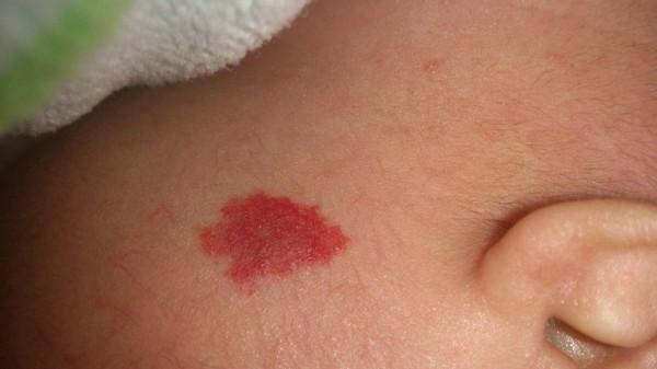 醫生眼中善良的6種“瘤”,查出來別怕,不會惡化,有的根本不是腫瘤 醫生眼中善良的6種“瘤”,查出來別怕,不會惡化,有的根本不是腫瘤