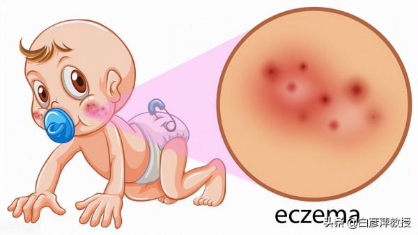 嬰幼兒溼疹，寶媽們該如何護理？