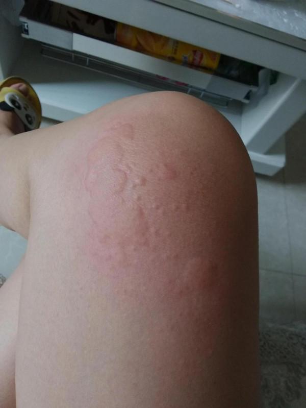 中醫裡的抗過敏藥