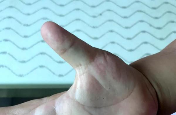 大排畸能檢查出手部畸形的寶寶嗎？