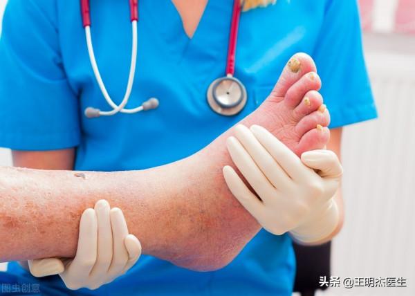 腿腳麻木冰冷,可能是下肢血管堵塞了!教你幾招還你一雙暖腳 腿腳麻木冰冷,可能是下肢血管堵塞了!教你幾招還你一雙暖腳