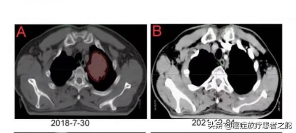 巨塊肝癌晚期伴復發轉移,如何成功抗癌至今8年有餘? 巨塊肝癌晚期伴復發轉移,如何成功抗癌至今8年有餘?