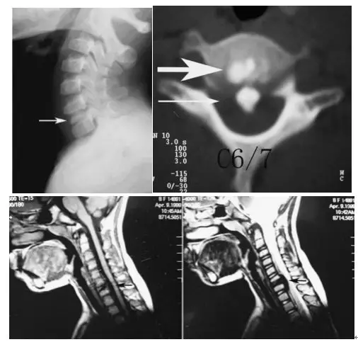 頸椎少見的3種鈣化性疾病 頸椎少見的3種鈣化性疾病