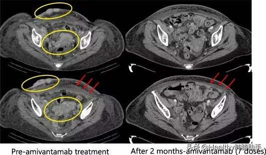往期治療均耐藥，順式C797S突變，Amivantamab有效