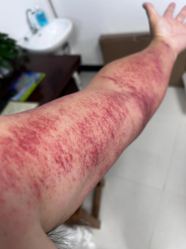 艾灸調理身體效果看的見