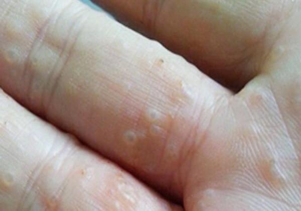 再次提醒：汗皰疹反覆性發作，瘙癢難耐，不妨用這3個方法解決