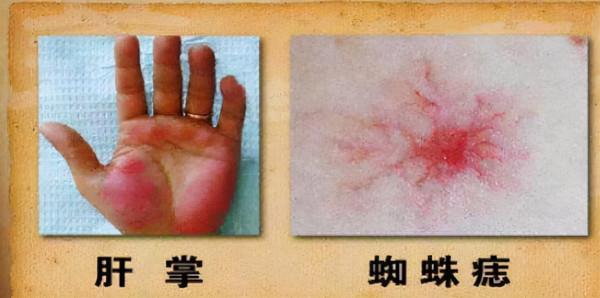 如果肝臟有問題，或許手上有這&OpenCurlyDoubleQuote;4個標誌&rdquo;，不妨瞭解一下