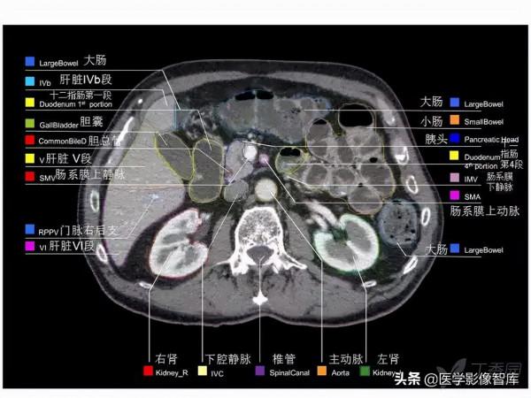 CT斷層解剖圖譜最全總結「推薦收藏」 CT斷層解剖圖譜最全總結「推薦收藏」