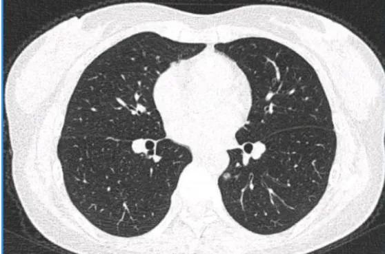 磨玻璃肺結節消融是比手術更好的選擇嗎？患者消融後反而更焦慮了